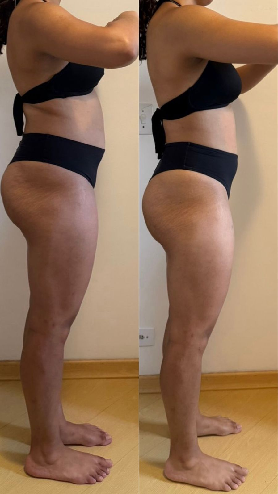 Transformação de paciente — lateral, antes e depois do Método Essência